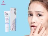 Review Kem Trị mụn thâm Megaduo