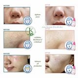  Tinh Chất Tẩy Tế Bào Chết Hóa Học Beplain BHA Peeling Ampoule 30ml 