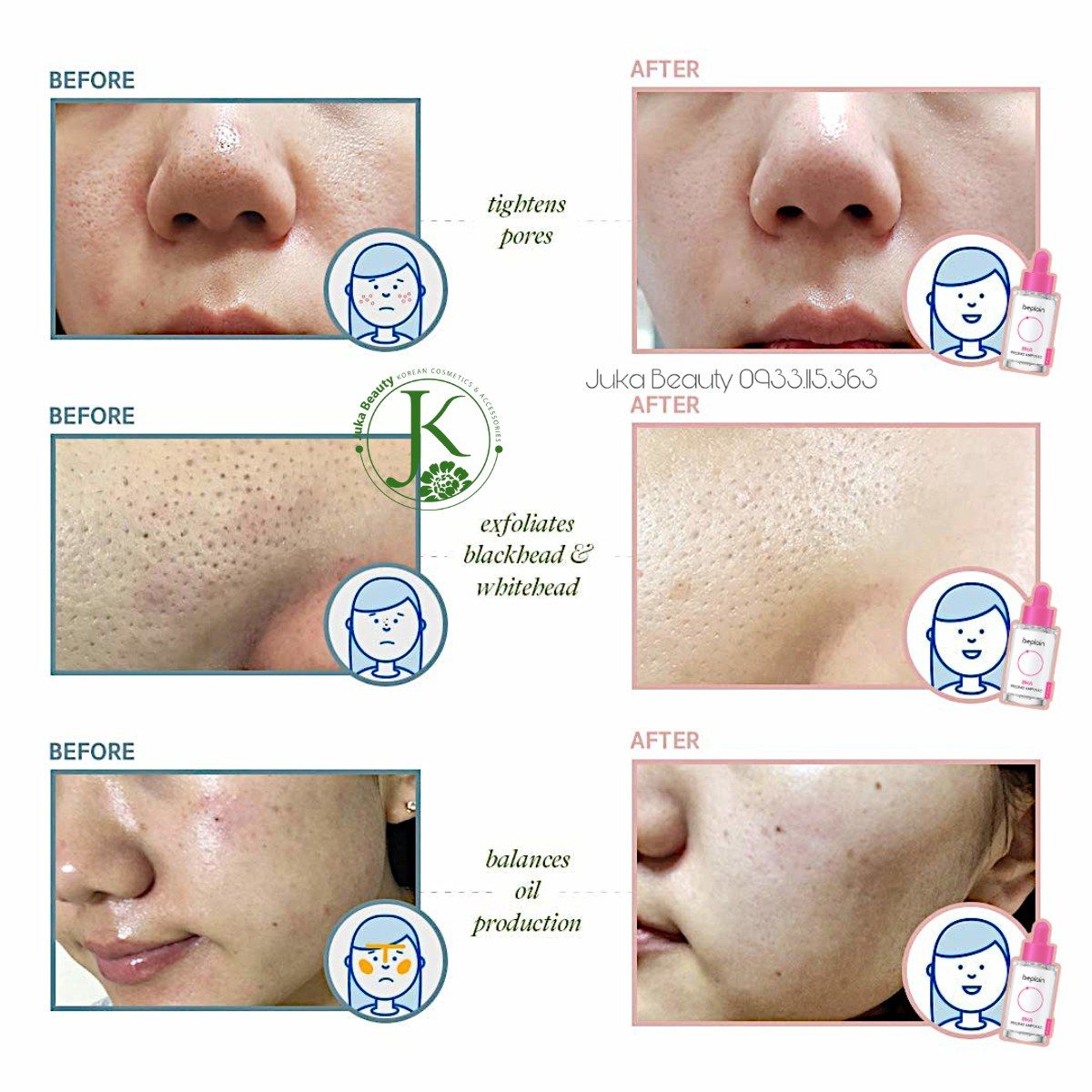  Tinh Chất Tẩy Tế Bào Chết Hóa Học Beplain BHA Peeling Ampoule 30ml 
