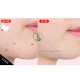  Kem Chấm Mụn Xẹp Mụn, Ngừa Thâm Tiam AC Fighting Spot RX Cream 30g 