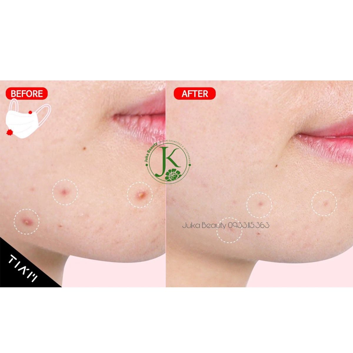  Kem Chấm Mụn Xẹp Mụn, Ngừa Thâm Tiam AC Fighting Spot RX Cream 30g 