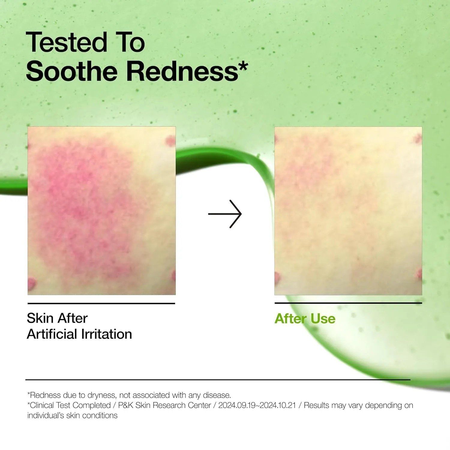  Tinh Chất Dịu Da, Mờ Thâm Mụn Anua Azelaic Acid 10 Hyaluron Redness Soothing Serum 30ml 