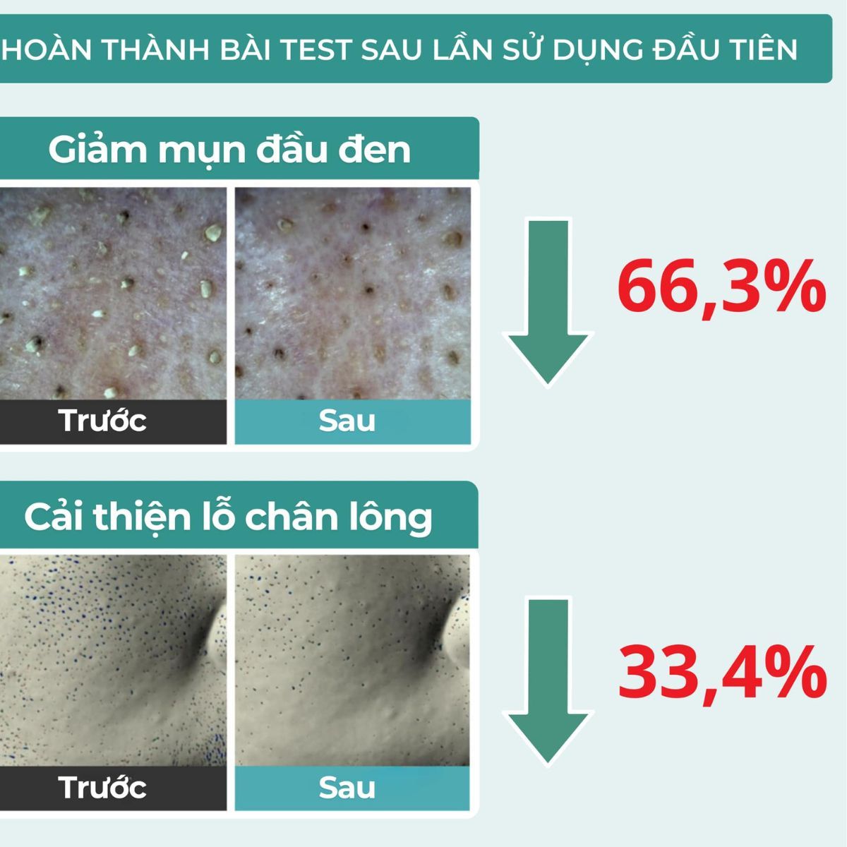  Tinh chất ủ mụn, giảm mụn đầu đen Jumiso Blackhead Melting Softener Special Kit 150ml 