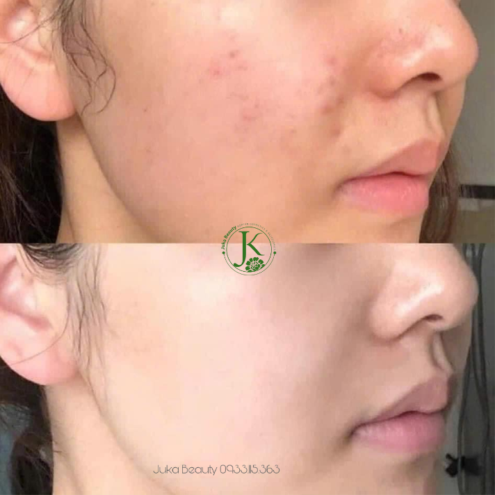  Kem Dưỡng Ẩm Cho Da Dầu Mụn Laboratorios Babe Stop Akn Mattifying Moisturiser 50ml 