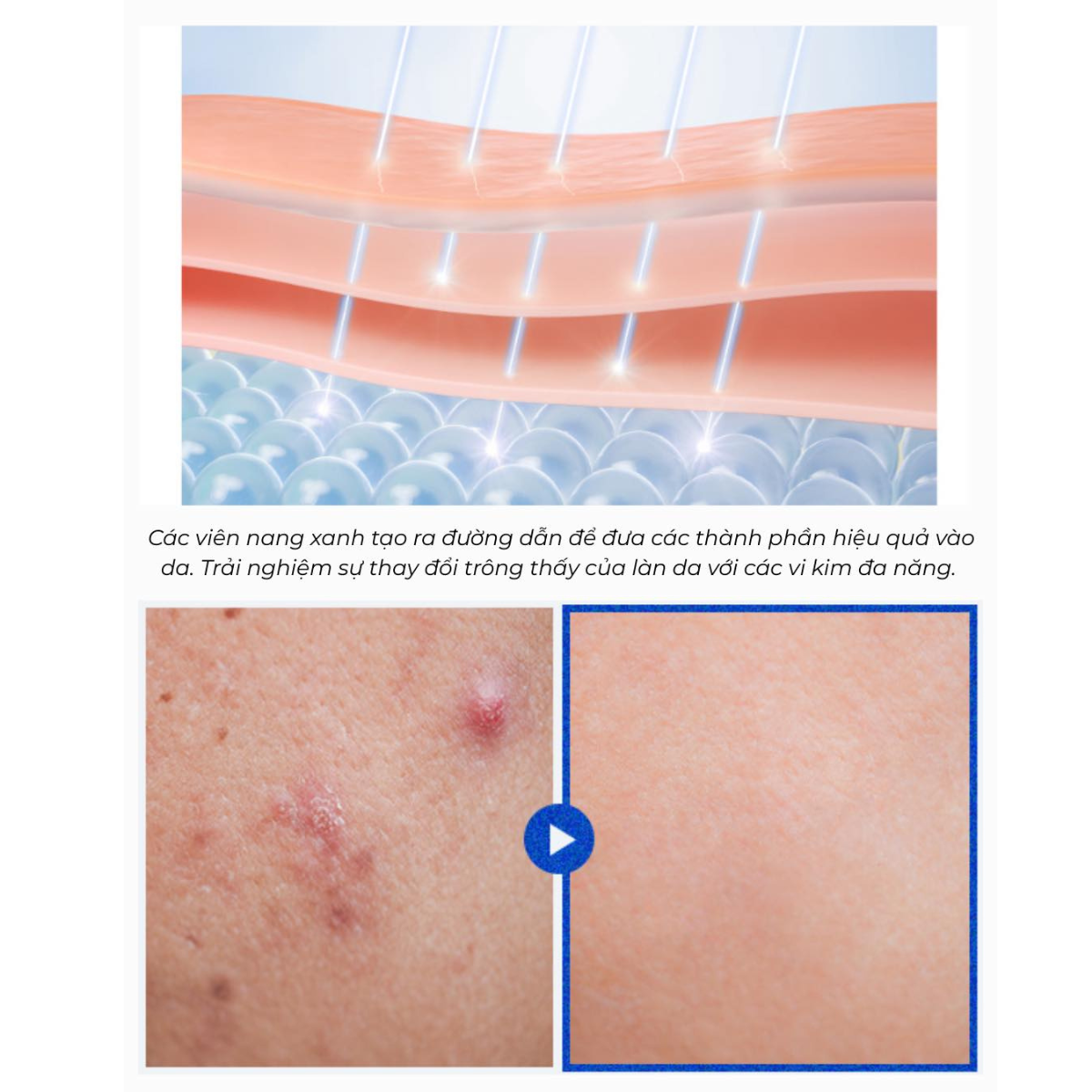  (Mẫu mới) Tinh chất vi kim tái tạo da Wonjin Effect Spicule Capsule Teca Serum 30ml 