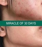  Kem dưỡng ẩm, giảm mụn Some By Mi AHA BHA PHA 30 Days Miracle Cream 60g (Mẫu mới) 