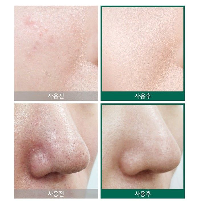  Nước Hoa Hồng Giảm Mụn 30 Ngày Some By Mi AHA BHA PHA 30 Days Miracle Toner 150ml 