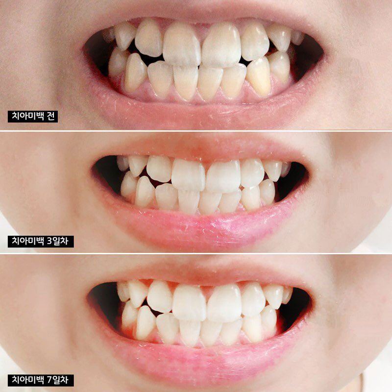  Kem Đánh Răng Median Dental IQ 93% Làm Trắng Sáng Răng 