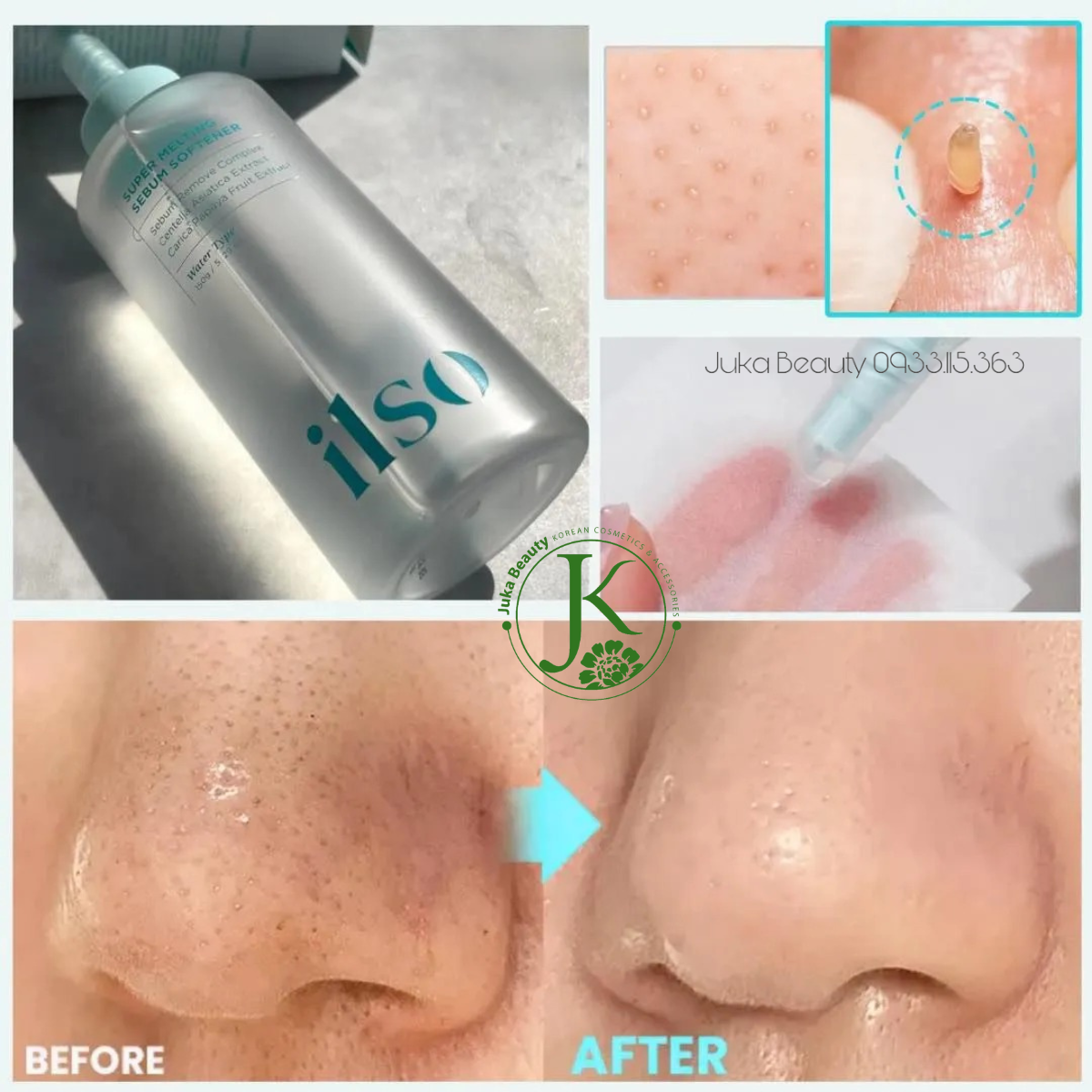  Tinh Chất Ủ Mụn Đầu Đen Ilso Sebum Super Melting Serum Softener 150ml 