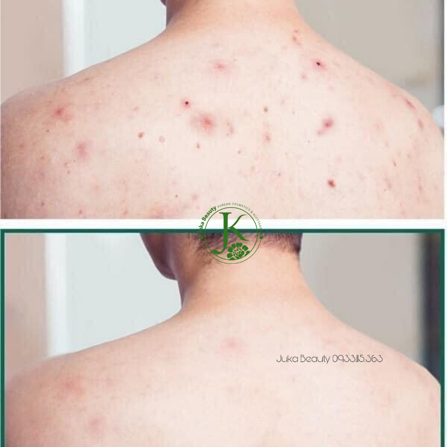  (Mẫu mới) Sữa Tắm Giảm Mụn Lưng Some By Mi AHA BHA PHA 30 Days Miracle Acne Clear Body Cleanser 400ml 