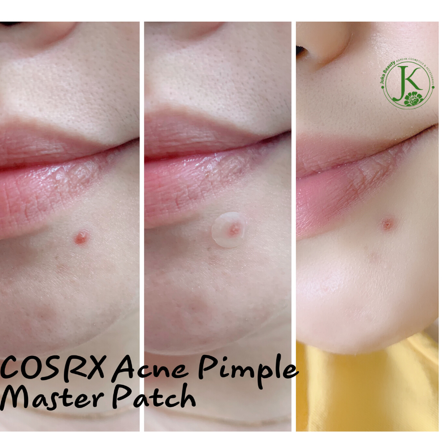 Miếng Dán Mụn Cosrx Master Patch 