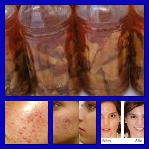 Trị Mụn Với Cây Mật Gấu