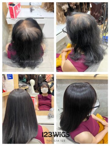Mái hói da đầu 4931