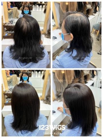 Mái hói da đầu 4920