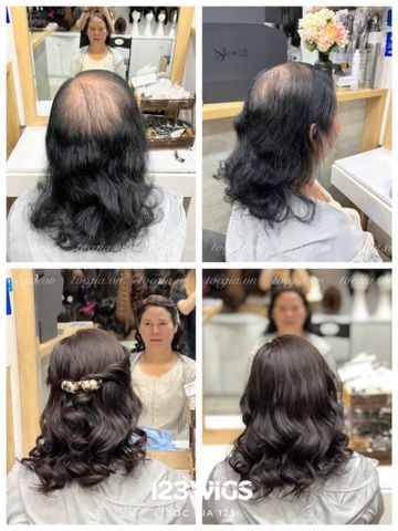 Mái hói da đầu 4919