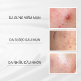  Nước cân bằng cho da mụn D Program Microbiome Acne care Lotion 125ml 