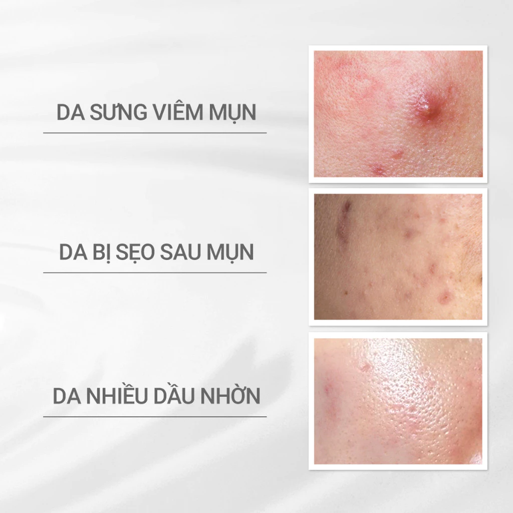 Nước cân bằng cho da mụn D Program Microbiome Acne care Lotion 125ml 