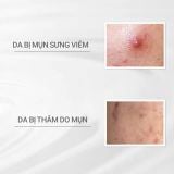  Tinh chất giảm mụn và làm mờ vết thâm D Program Acne Care Spot Essence 15g 