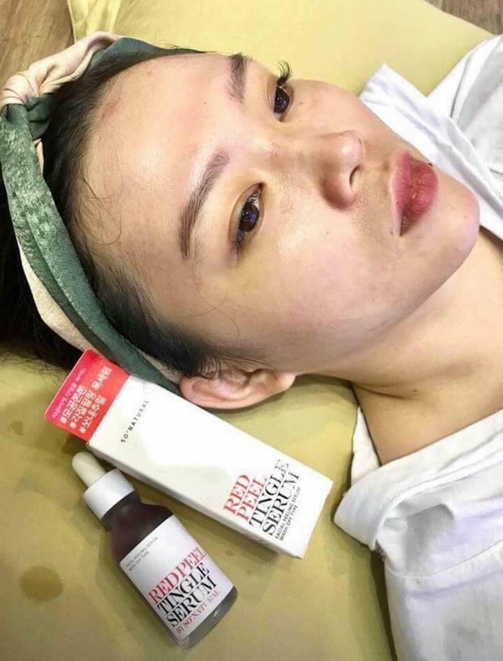 peel da mặt-peel da trị mụn-bicicosmetics.vn 