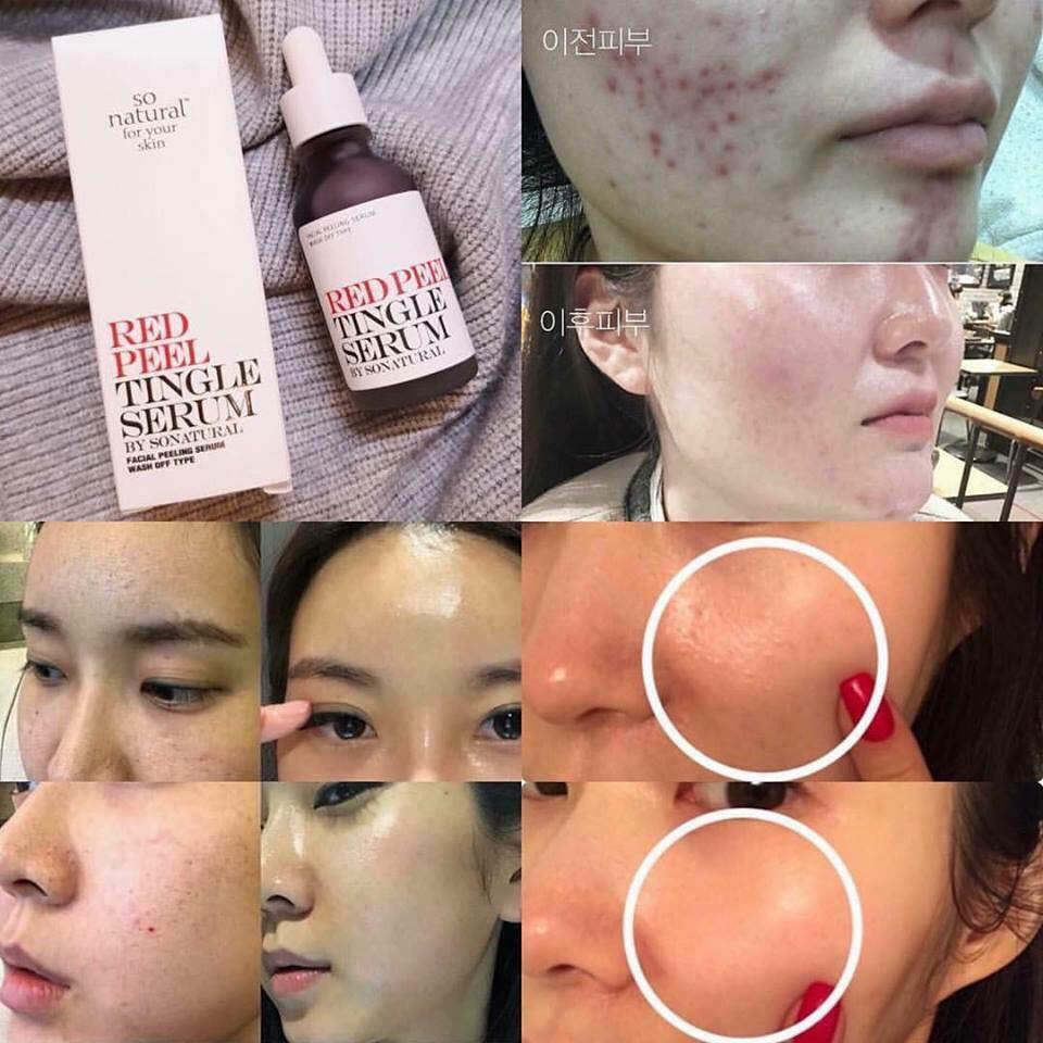 SoNatural Red Peel Tingle Serum-bicicosmetics.vn