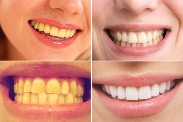 Sản phẩm giúp làm trắng răng cấp tốc