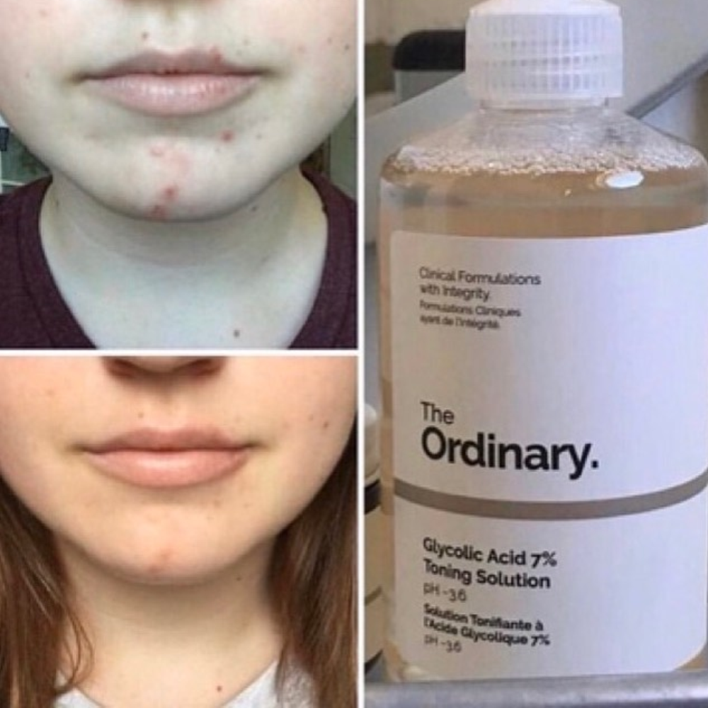  Nước Hoa Hồng The Ordinary 240ml - Glycolic Acid 7 Toning Solution 