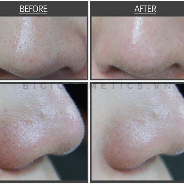Cọ tẩy mụn đa năng RIRE Style Blackhead Brush Cleanser