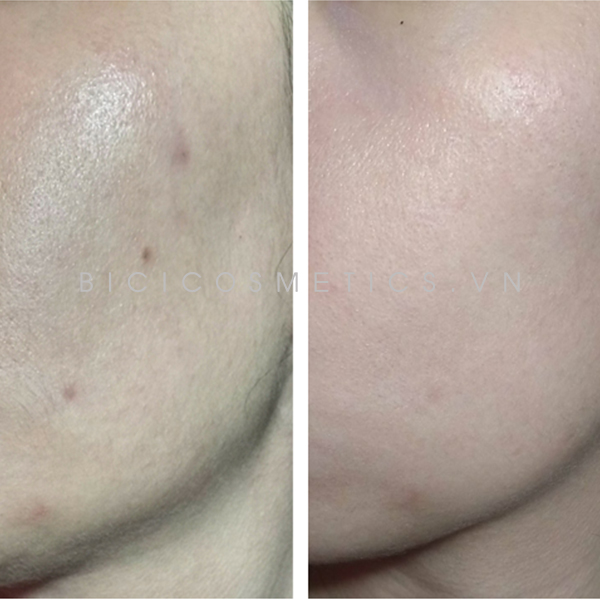 Trước và sau khi sử dụng Rohto Melano CC Anti Spot Essence 1