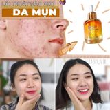  Tinh Chất Trị Mụn Derladie Witch Hazel Perfect Vitamin Serum (35ml) 