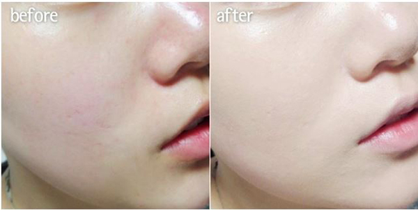 Trước và sau khi sử dụng Tế Bào Gốc Eldas Trước và sau khi sử dụng Tế Bào Gốc Eldas