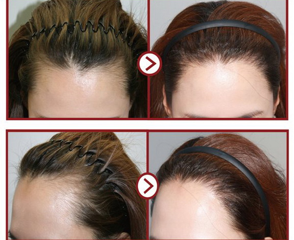 Dầu gội Hunca Care tỏi & nguyệt quế kích thích mọc tóc hiệu quả 1