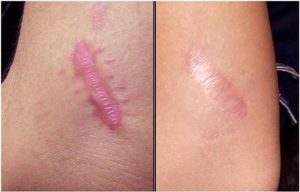 Trị sẹo lõm, sẹo lồi 2 Trị sẹo lõm, sẹo lồi 1