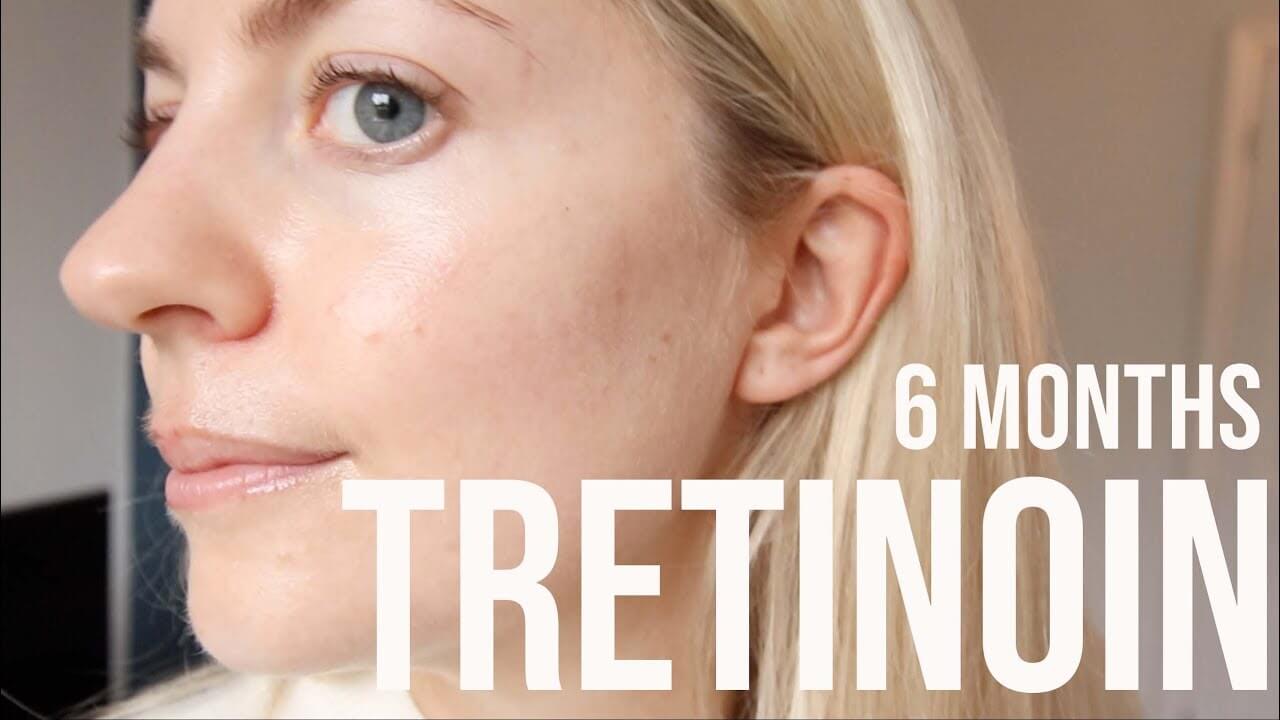 trị mụn bằng tretinoin-bicicosmetics.vn