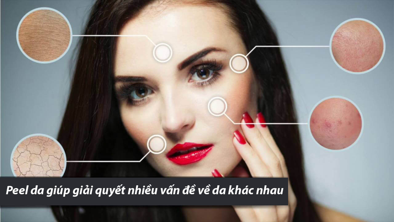 peel da mặt-peel da trị mụn-bicicosmetics.vn