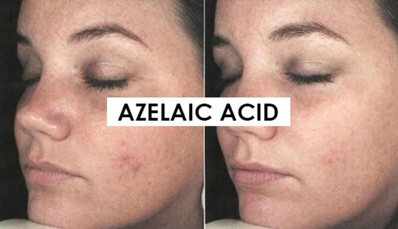 Acid Azelaic là cách ức chế sự sinh sôi của các vi khuẩn gây mụn - BICI COSMETICS