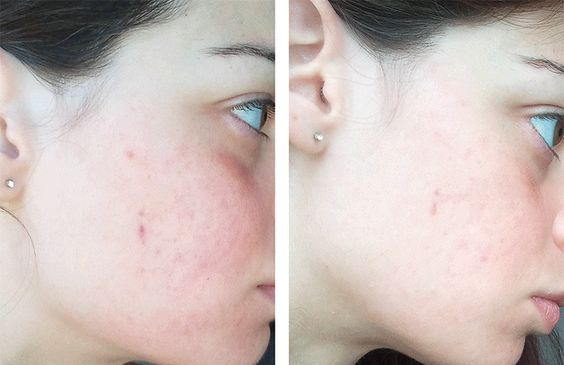 Trước và sau khi sử dụng Meishoku Bigansui Medicated Skin Lotion 1