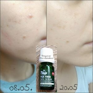 Serum Trị Mụn Tea Tree Trị Mụn hiệu quả 2 Serum Trị Mụn Tea Tree Trị Mụn hiệu quả 1