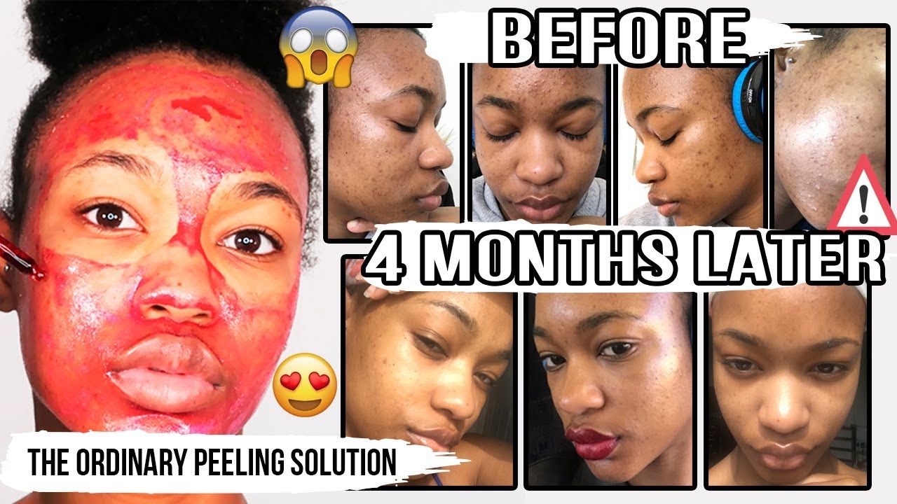 SoNatural Red Peel Tingle Serum-bicicosmetics.vn