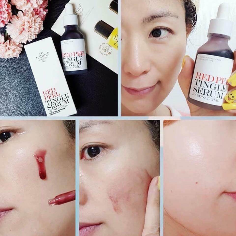 peel da mặt-peel da trị mụn-bicicosmetics.vn