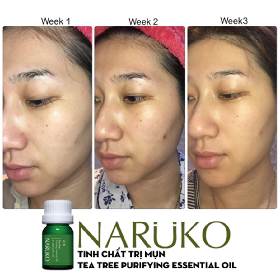 Tinh Dầu Trị Mụn NARUKO Tea Tree Purifying Essential Oil - bici cosmetics