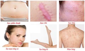 Công dụng trị sẹo tuyệt vời! 2 Công dụng trị sẹo tuyệt vời! 1