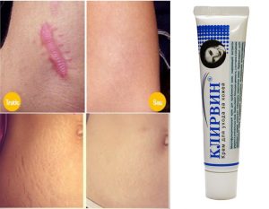 Kem trị sẹo Klirvin trị rạn da hiệu quả 2 Kem trị sẹo Klirvin trị rạn da hiệu quả 1
