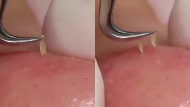Vacosi Blackhead Tweezers giúp loại bỏ nhân mụn dễ dàng 1