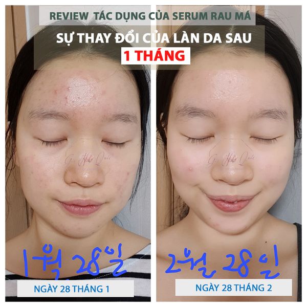  Serum rau má trị mụn Skin 1004 Madagascar Stella 