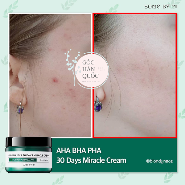  KEM DƯỠNG CHO DA MỤN SOMEBYMI AHA-BHA-PHA 30 DAYS MIRACLE CREAM 50ML 