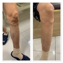 Máy nén ép trị liệu suy giãn tĩnh mạch chân Kachi MK394