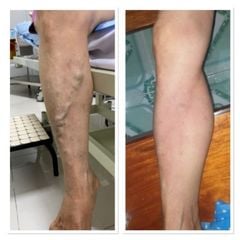 Máy nén ép trị liệu suy giãn tĩnh mạch chân Kachi MK394