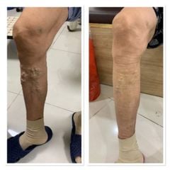 Máy nén ép trị liệu suy giãn tĩnh mạch chân Kachi MK394