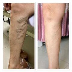 Máy nén ép trị liệu suy giãn tĩnh mạch chân Kachi MK394