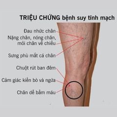 Máy nén ép trị liệu suy giãn tĩnh mạch chân Kachi MK394